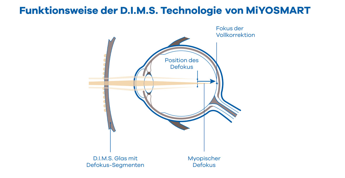 hoya-miyosmart-info-4