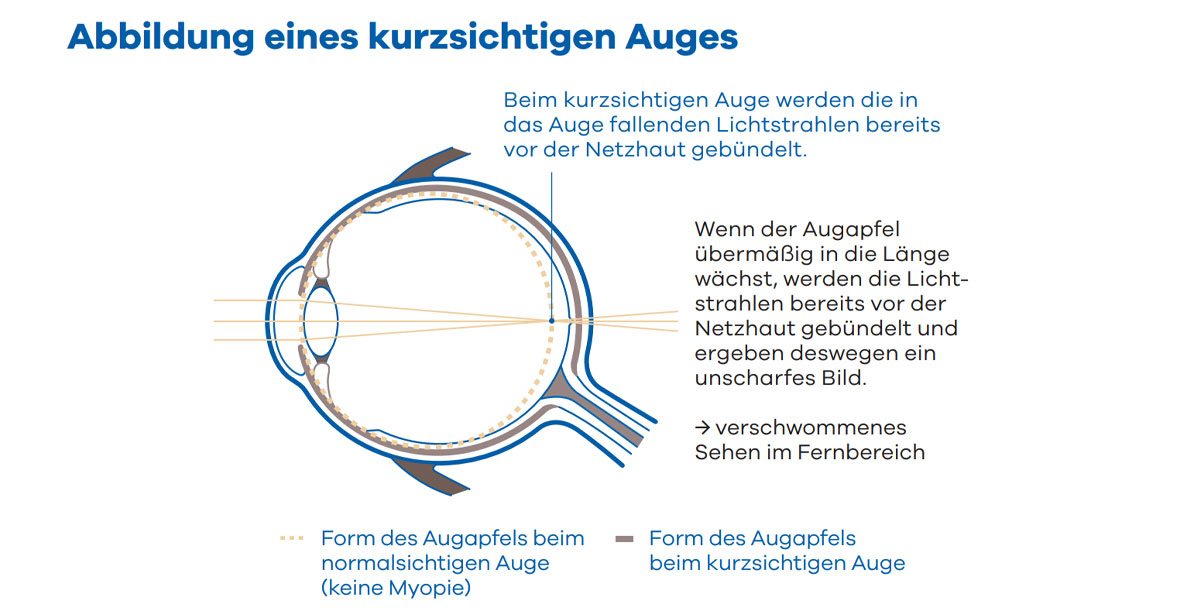 hoya-miyosmart-info-5